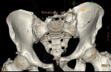 Pelvis APC 2